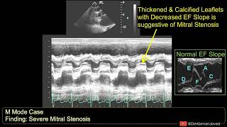 Mitral Stenosis on M Mode Echocardiogram  Echocardiography For Beginners [upl. by O'Meara]