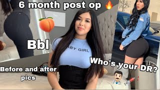 BBL 6 Month Post Op QampA Results Doctor info etc [upl. by Kowtko]