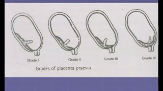 Antepartum Haemorrhage Lecture in Hindi  APH in Pregnancy  causes  Obstetrics and Gynecology OBS [upl. by Bigford]