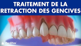 Récession Gingivale – Traitement de la retraction des gencives © [upl. by Rednave]