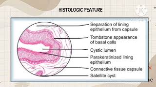 ODONTOGENIC KERATOCYST Histology and Pathogenesis [upl. by Iosep984]