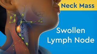 Neck Mass Swollen Lymph Node [upl. by Mages]