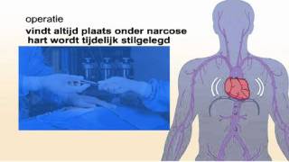 Bypassoperatie  Wat houdt deze behandeling in [upl. by Bev]