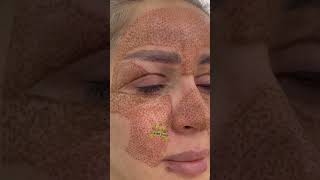 Fibroblastplasma fibroblastskintightening ترند fibroblasting skincare [upl. by Dukie64]