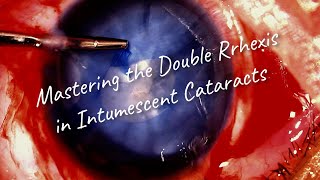 How to Master the Double Rhexis Technique for intumescent cataract  a video guide [upl. by Annyahs279]