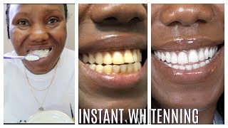 How I whitened my yellow teeth in 2 Minutes  LIVE DEMO HOME REMEDY [upl. by Hplodur]