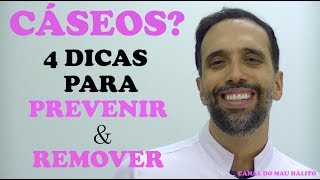 4 DICAS para PREVENIR e REMOVER CÁSEOS [upl. by Nagy]