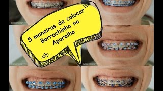 5 Maneiras de Colocar Borrachinha no Aparelho [upl. by Eixela]