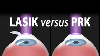 LASIK or PRK Which is right for me Animation [upl. by Haizek]