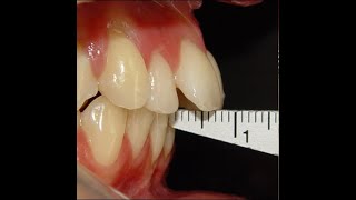 Non Surgical Orthodontic treatment of Skeletal Class II with 7mm Overjet [upl. by Erialb]