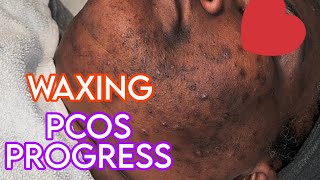 WAXING PCOS PROGRESS Bye Inflammation RESULTS [upl. by Notgnilra34]