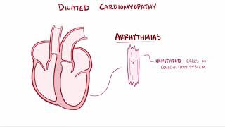 Dilated cardiomyopathy DCM causes symptoms diagnosis treatment amp pathology [upl. by Amberly]