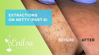 Blackhead Extractions on Netty  Eight Treatment [upl. by Atlanta779]