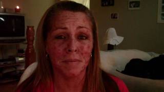 Skin Cancer My Vlogjournal Treatment W EFUDEX vid8 [upl. by Ardnovahs]