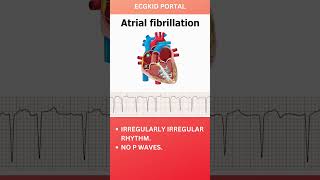 Atrial Fibrillation Anatomy ECG icu medicine emergencymedicine atrialfibrillation [upl. by Aisyle]