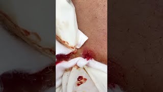 Big Cystic Acne Blackheads Extraction Blackheads amp Milia Whiteheads Removal Pimple Popping shorts [upl. by Esekram]