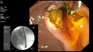 ERCP  Papillitis from recently passed CBD stone [upl. by Ardnasal901]