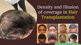 Density and Illusion of coverage in Hair Transplantation  Bisanga Hair Restoration BHR Clinic [upl. by Beeck]