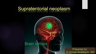 6Supratentorial brain neoplasm [upl. by Tilford]