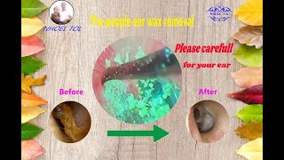 Relax Everyday With Satisfying Ear Wax Removal 01 [upl. by Alaric]