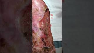 Venous stasis ulceration with pyoderma gangrenosum [upl. by Renrag]