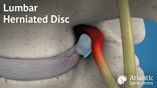 Lumbar Herniated Disc Overview [upl. by Neras]