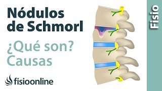 Nódulos de Schmorl  ¿Qué son y cómo sucede [upl. by Kyriako]