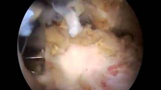 Arthroscopic Subscapularis repair and biceps tenodesis [upl. by Durante]