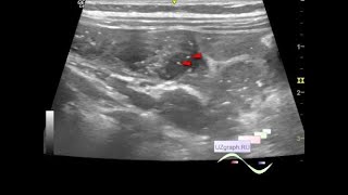 Pediatric Abdominal Ultrasound  Necrotizing Enterocolitis [upl. by Battista]