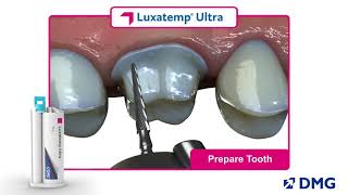 Luxatemp Ultra Rated 1 in Flexural Strength [upl. by Edme648]