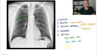 Rx Torax 2 PA Estructuras óseas [upl. by Erdnaed]