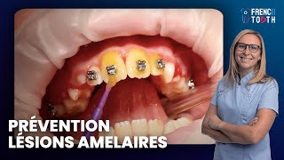 Prévention lésions amelaires en Orthodontie avec vernis fluoré Duraphat  Dr Médio [upl. by Ennayhc]