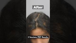 PRP Results Before amp After 2 Sessions prptreatment hairlosstreatment [upl. by Nerual]