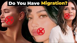 Are Your Lips BOTCHED  3 Signs You Have Lip Filler MIGRATION  Dissolving Lip Filler [upl. by Idola159]