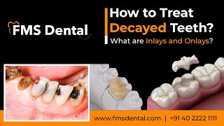 How to Treat Decayed Teeth What are Inlays and Onlays by FMS Dental [upl. by Hannavas125]