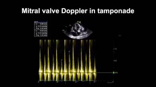 Echocardiography Essentials Detecting pericardial effusions [upl. by Pedroza]