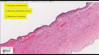 Serous cystadenoma [upl. by Dowzall]