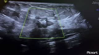 Breast cancer malignant mass ultrasound biopsy proved BIRDAS 6 sonography ARDMS [upl. by Herc]