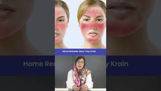 Doctor tells home remedies to Treat Rosacea  shorts skincare disease rosacea [upl. by Eadith]