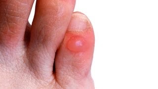 How to Prevent amp Treat Foot Blisters  Foot Care [upl. by Ainimre]