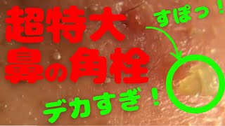 【角栓マニア】鼻の巨大角栓と細かな角栓をピンセットで抜いてみたpimplepopping blackheads whiteheads [upl. by Jelene]