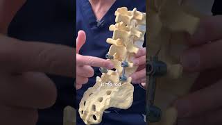 Know more about Pedicle Screws [upl. by Ameg660]