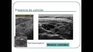 ENDOCRINOLOGÍA 3 Nódulo tiroideo [upl. by Aratihc]