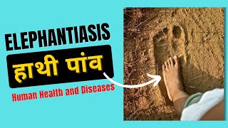 Elephantiasis Symptoms  Filariasis Class 12  Human Health and Diseases [upl. by Adihsaar779]