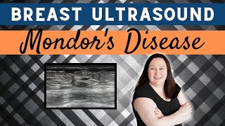 Breast Ultrasound Pathology Gallery  Mondors Disease [upl. by Acireed]