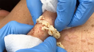 Stubborn Sac and Cyst Removal  CONTOUR DERMATOLOGY [upl. by Irrep]