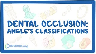 Dental occlusion  Angle’s classifications [upl. by Yslehc]