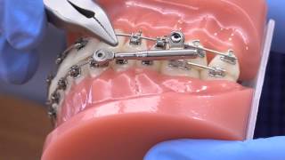 American Orthodontics PowerScope Activation [upl. by Oiramal]