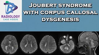 Joubert syndrome with corpus callosal dysgenesis [upl. by Leahcimaj]