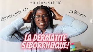 Démangeaison pellicules cuir chevelu irrité  Je souffre de dermatite séborrhéique [upl. by Lavud]